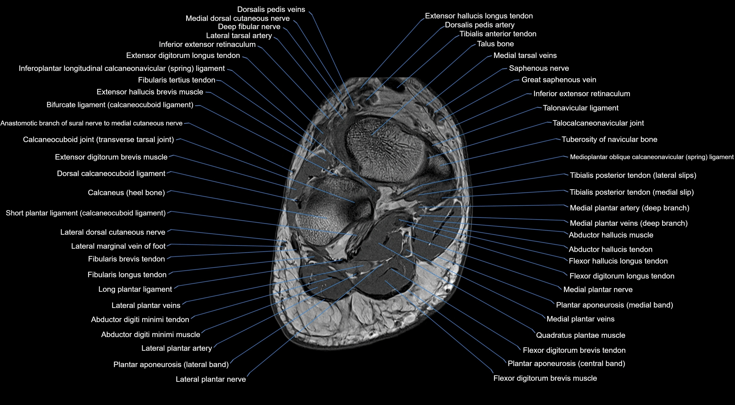 MRI mid foot coronal ligaments cross sectional anatomy 3T  radiology  image-img-00001-00036.webp